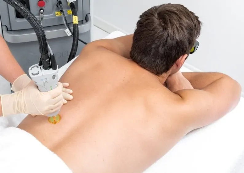 Laser Hair Removal for Men Full Back & Shoulders (as low as €99.90 per session)